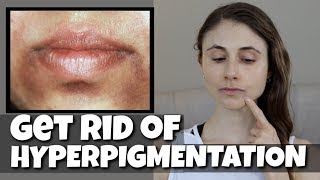 GET RID OF HYPERPIGMENTATION AROUND THE MOUTH DR DRAY [upl. by Kuhlman]