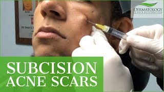 Subcision for ACNE SCARS  Procedure  Dr Ben Behnam  Los Angeles [upl. by Juxon269]