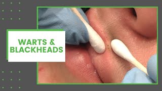 Warts amp Blackheads  Dr Derm [upl. by Noirad]