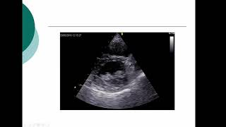 Lecture 3  Transthoracic Echocardiography Part 2 [upl. by Queston182]