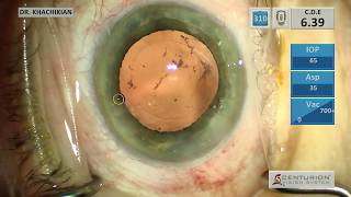 Laser Cataract Surgery [upl. by Gamaliel702]