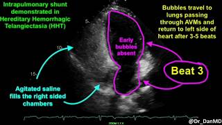 Cavernous Malformations Symptoms Treatments amp FAQs [upl. by Leavitt]