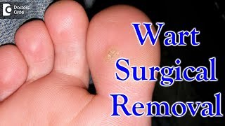 Wart surgical removal  Dr Urmila Nischal [upl. by Atilam]