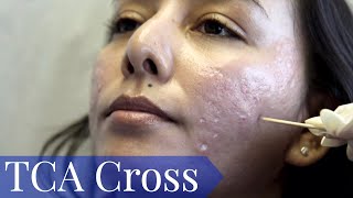 TCA Cross for deep Acne Scars for olive skin tone PART ONE [upl. by Jeni741]