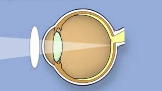 Retinoscopy of the eye Ophthalmology [upl. by Shay]