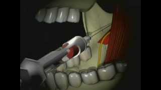 Mandibular Anesthesia  Inferior Alveolar Nerve Block [upl. by Edda439]