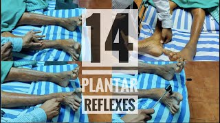 14 Abnormal plantar reflexes Babinski equivalents [upl. by Darryl]