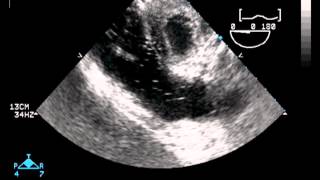 Transesophageal Echocardiography [upl. by Pauletta]