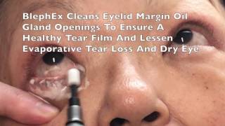 BlephEx Eyelid Treatment For Dry Eyes Blepharitis by Dr Burroughs in Colorado Springs [upl. by Aveneg]