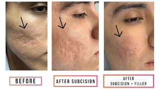 Subcision  Filler for Acne Scars [upl. by Ulrica]