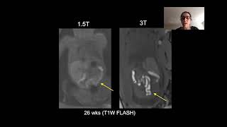 Fetal Heart Beat Audio 11 Weeks Pregnant [upl. by Assirol]