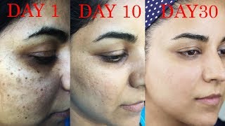 How I Got Rid of Dark Scars Hyperpigmentation PimplesAcne [upl. by Michella494]