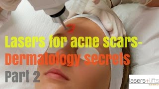 Laser Resurfacing for ACNE SCARS Secrets revealed [upl. by Narra]