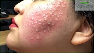 Acne Scar Treatment TCA Cross using TCA 80 [upl. by Sutherland]