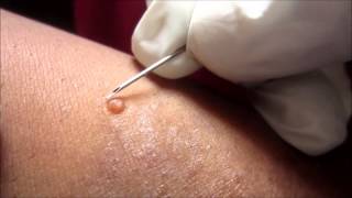 Removing H P Body From Molluscum Contagiosum [upl. by Eed478]