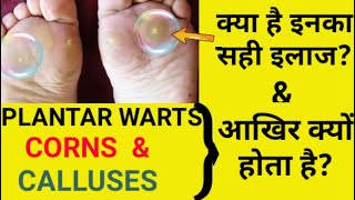 Plantar warts Corns amp Calluses Causes Symptoms amp Treatment [upl. by Onra]