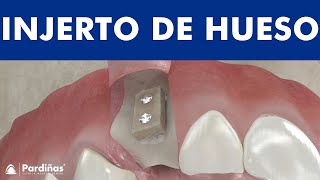 INJERTOS de HUESO para REGENERACIÓN en IMPLANTES DENTALES  Bloque y particulado © [upl. by Buonomo]