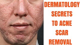 Acne scar treatments ULTIMATE GUIDE [upl. by Esined]