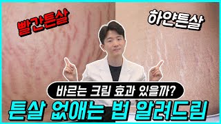 튼살 없애는 방법 빨간 튼살 하얀 튼살의 치료 관리 예방법 알려드립니다  피부과전문의 닥터피부광 [upl. by Jeuz793]