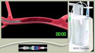 Understanding and Diagnosing Venous Thromboembolism VTE [upl. by Araid]