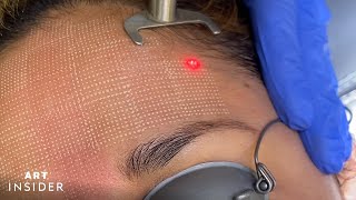 Minimize Acne Scarring With Laser Resurfacing [upl. by Balcke]