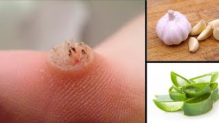 How To Remove Warts At Home Naturally [upl. by Ole]