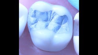 Class II Amalgam Restoration 1  Operative Dentistry [upl. by Aizan]