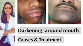 Darkening around mouth  causes  treatment  Dermatologist  Dr Aanchal Panth [upl. by Denbrook]