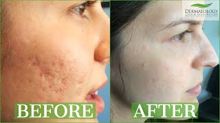 ICE PICK SCAR Acne Results Testimonial  TCA CROSS  Dr Ben Behnam  Los Angeles [upl. by Ocsic]