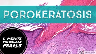 Porokeratosis 5Minute Pathology Pearls [upl. by Strohben]