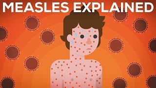 Measles Explained — Vaccinate or Not [upl. by Nollahs]