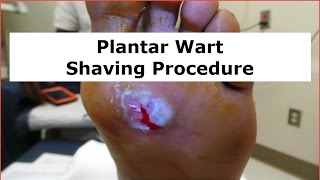 Plantar Wart Shaving Procedure [upl. by Meisel93]