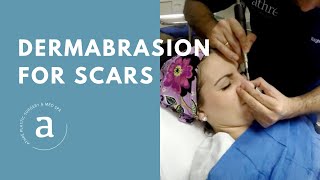 Dermabrasion for Scars  Live Demo by Dr Athre [upl. by Enyrhtak506]