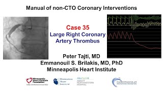 Case 35 PCI Manual Large RCA thrombus [upl. by Tnafni]