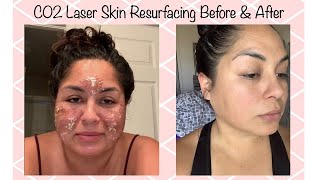 C02 Laser Resurfacing For Acne Scar Removal  My 7 Day Review [upl. by Nolyarg]