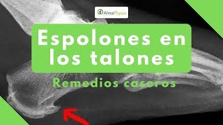 espolones en los talones remedios caseros [upl. by Asillim668]